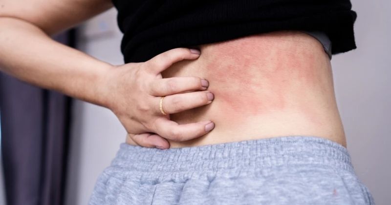 Nổi mề đay, mẩn ngứa dai dẳng không rõ nguyên nhân là một trong những dấu hiệu lâm sàng chỉ điểm tình trạng nhiễm ký sinh trùng trong máu.